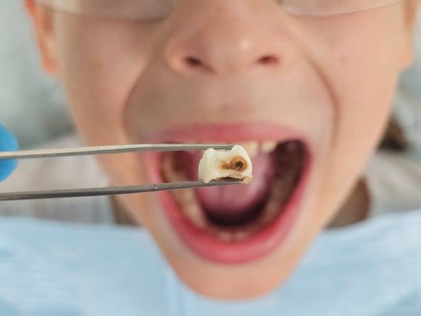 Best Emergency Tooth Extraction in Summit, MS